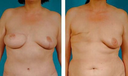 Amputee Mastectomy Handicapped