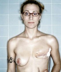 Amputee Mastectomy Handicapped