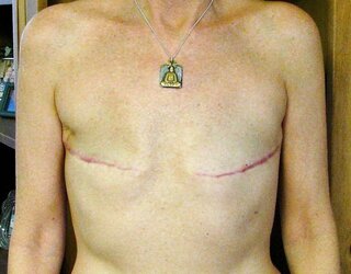 Amputee Mastectomy Handicapped