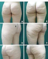 Hefty, White, and Cellulite