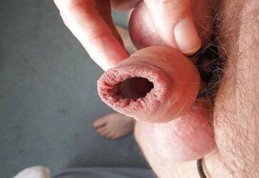 Cbt open up foreskin