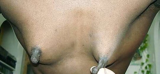 Deformed and saggy titts