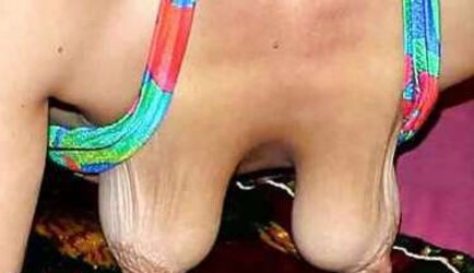 Deformed and saggy titts