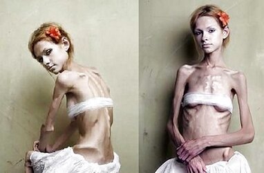 Anorexic Models