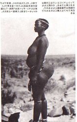 STEATOPYHGIA
