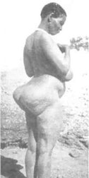 STEATOPYHGIA