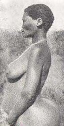 STEATOPYHGIA