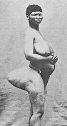 STEATOPYHGIA
