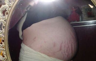 Vergeture - grossesse