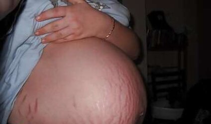 Vergeture - grossesse