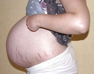 Vergeture - grossesse