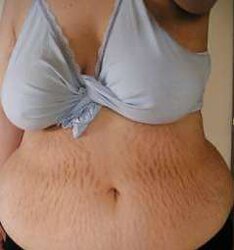Vergeture - grossesse