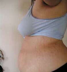 Vergeture - grossesse