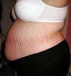 Vergeture - grossesse