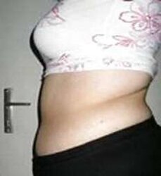 Vergeture - grossesse