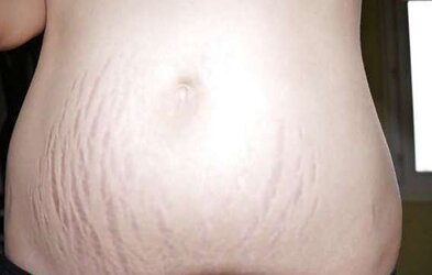 Vergeture - grossesse
