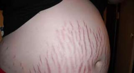 Vergeture - grossesse