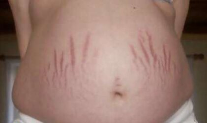 Vergeture - grossesse