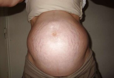 Vergeture - grossesse