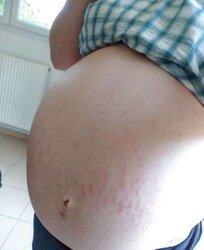 Vergeture - grossesse