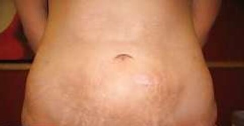 Vergeture - grossesse
