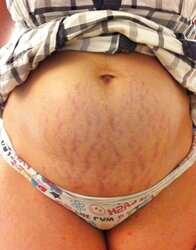 Vergeture - grossesse