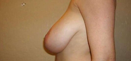 Big-Boobed Titty Reductions - Set