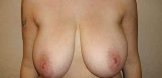 Big-Boobed Titty Reductions - Set