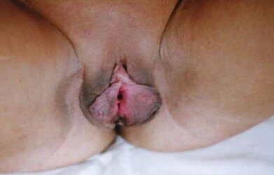 Schamlippen Schamlappen aufgespritzt